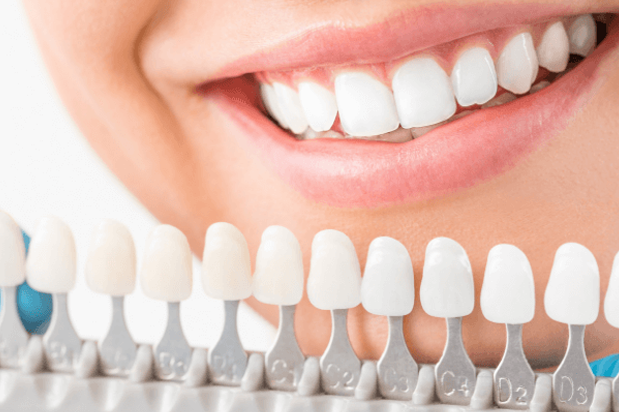 Teeth Whitening